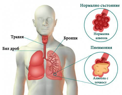 Симптоми на пневмония и средства за лечение