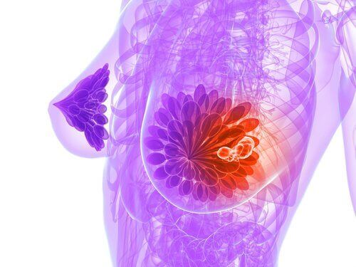 Много жени са диагностицирани с рак на гърдата и са живи и днес.