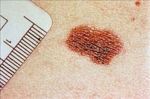 Видове рак на кожата