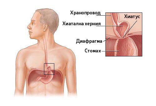 Може ли да се лекува хиатална херния?