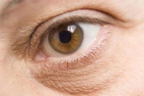 Натурални лечения за тъмните кръгове под очите