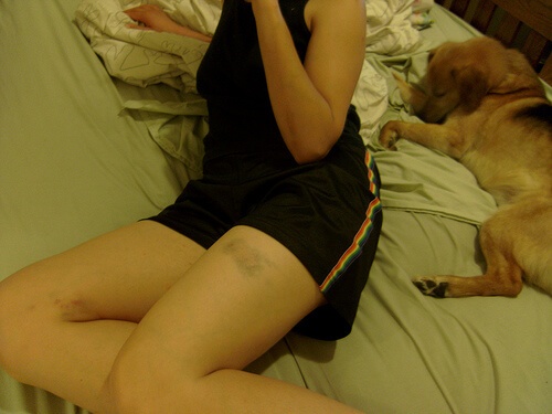 Синини по краката - екхимоза