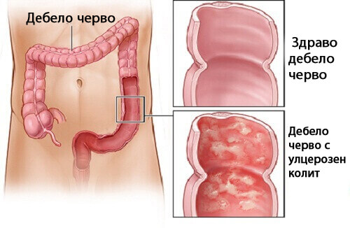 Домашно лечение на улцерозен колит