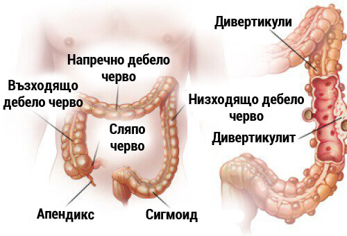 Дивертикулит и дивертикулоза: диагностика и лечение