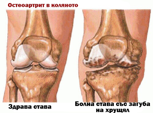 остеоартрит в коляното