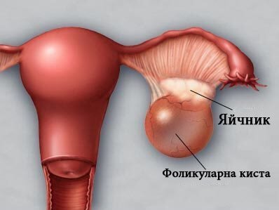 Ранна диагностика и превенция на кисти на яйчниците