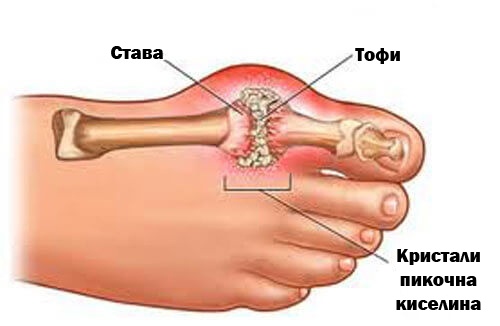 подаграта се получава в следствие на натрупване на пикочна киселина