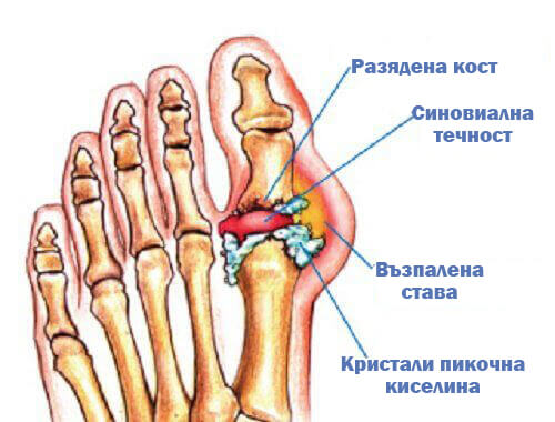 Сбогом на подаграта с това натурално средство