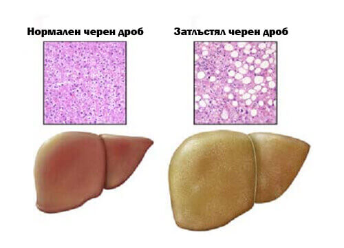 Разлика между нормален и мастен черен дроб.