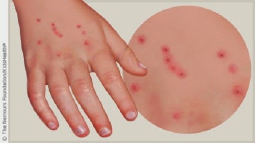 Един от първите симптоми на Лаймската болест е обрив по кожата.