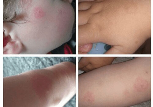 Рисковете на Лаймската болест