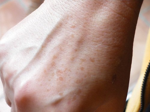 Намаляване или скриване на старчески петна и лунички по ръцете