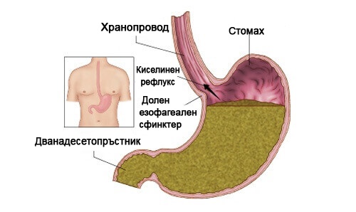 Рефлуксът и киселините често са свързани с натровен черен дроб.