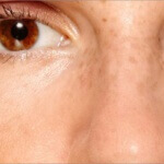 Как да намалим или премахнем пъпките от лицето