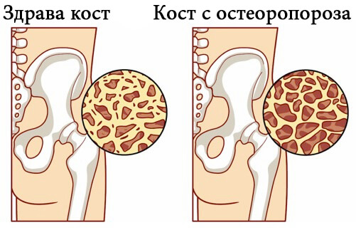 8 храни, които помагат за предотвратяване на остеопорозата