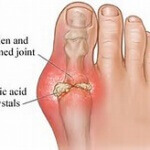 Опасностите от пикочната киселина и как да ги избегнем