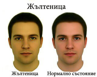 Жълтеницата е най-очевидният симптом на натровен черен дроб.