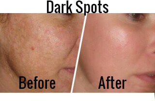 Ябълков оцет като средство срещу тъмни петна