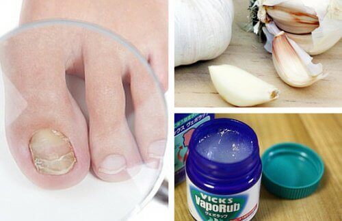 7 домашни средства против гъбични инфекции на ноктите