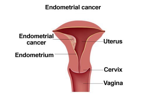 Рак на ендометриума - причини и лечение