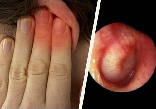 ушната кал може да предизвика болки в ухото