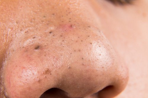 5 средства за лечение на черни точки