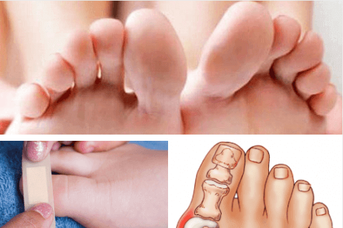 Как да лекуваме наранявания и заболявания на пръстите на краката