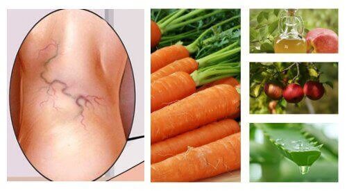 Натурално средство от 3 съставки при разширени вени