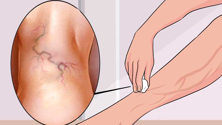 Алое вера, морков и ябълков оцет спомага за редуциране на разширените вени.