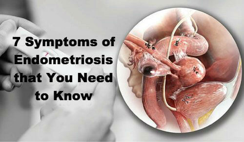 7 симптоми на ендометриозата, които трябва да познавате