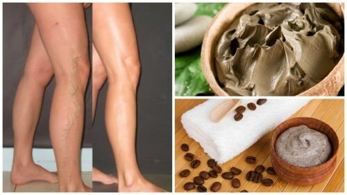 5 натурални начини за борба с разширени вени