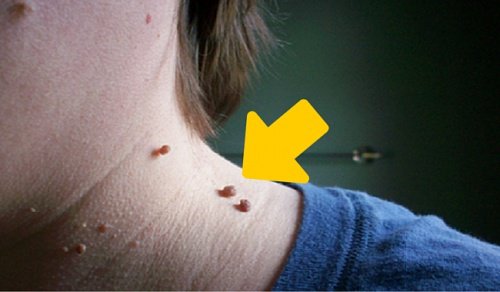 Папиломите: 6 съвета за елиминиране по естествен начин