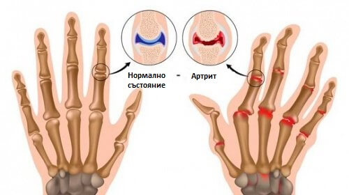Болезненият артрит: 5 неща, които вероятно не знаете за него