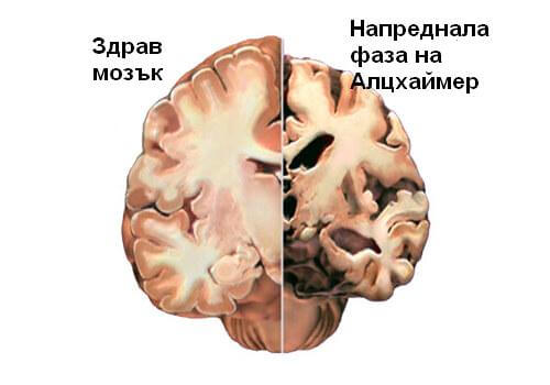 Открийте първите симптоми на Алцхаймер навреме