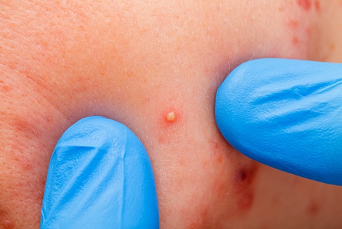 Акнето може да е признак за бъбречна недостатъчност.