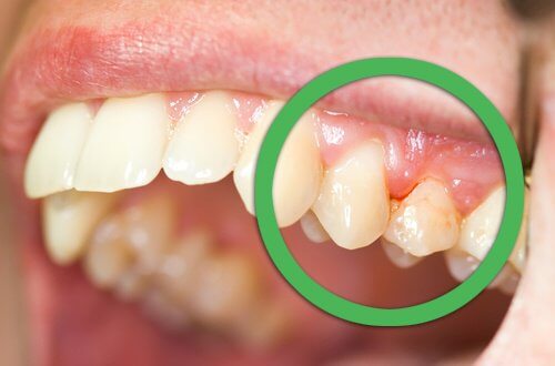 зъбобол при парадонтоза