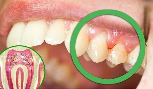 6 причини за зъбобол