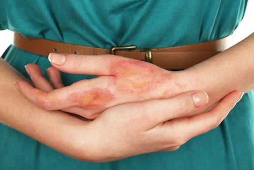 Различни инфекции може да доведат до рак на кожата.