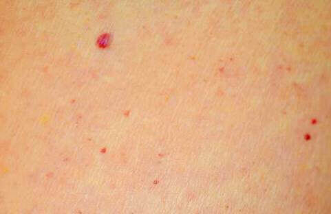 Червени бенки