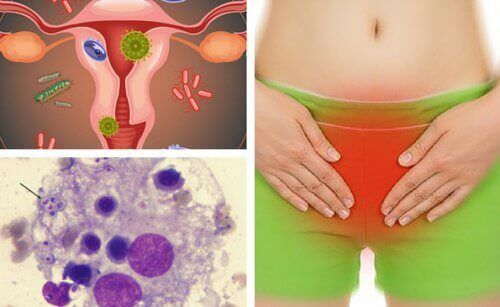 7 съвета за справяне с вагинални гъбични инфекции