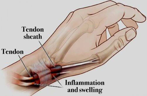 Теносиновит: възпаление на ръцете и краката