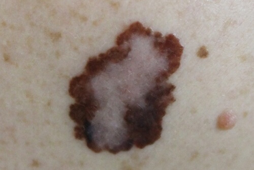 Симптом на рак на кожата - бенка.