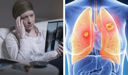 Ракът на белите дробове е много по-смъртоносен за жените