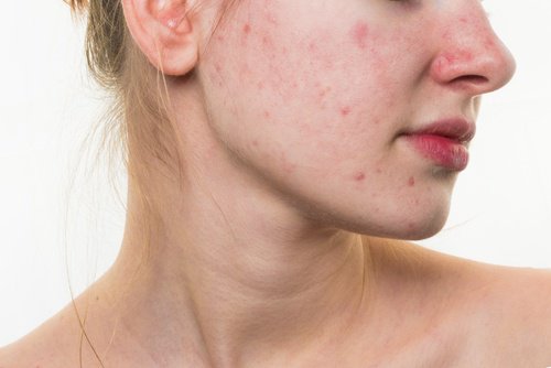 5 храни, които могат да съсипят кожата на лицето ви