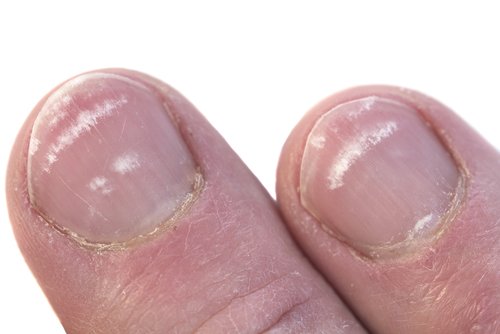Защо се появяват бели петна по ноктите?
