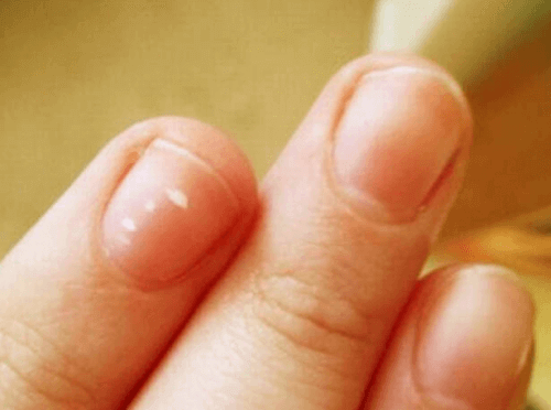 Има много причини за бели петна по ноктите.