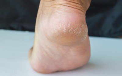 Vaporub против напукани пети