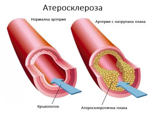 атеросклерозата и високия холестерол