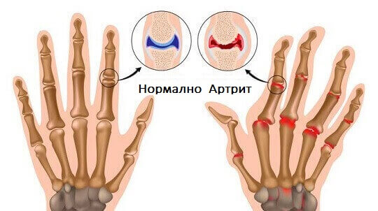 Методи за лечение на артрит