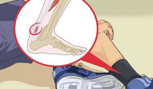 5 лечебни средства за тендинит на ахилесовата пета